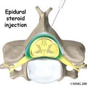 Epidural Steroid Injection